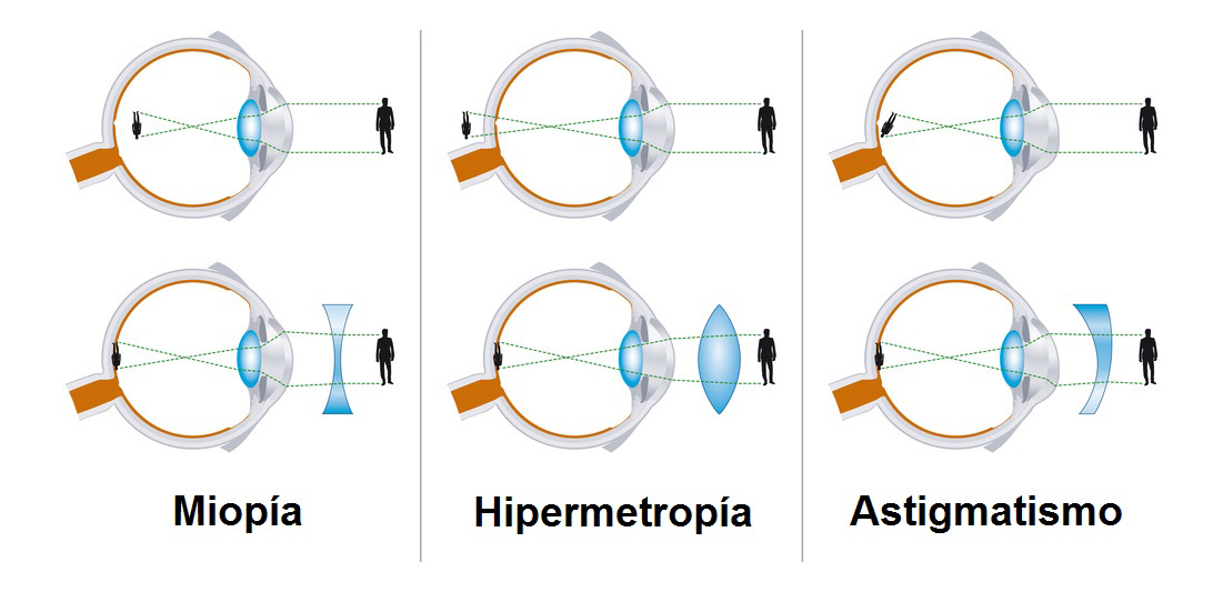 miopía, hipermetropía y astigmatismo)