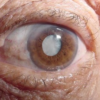 catarata-oftalmologista-neovisao